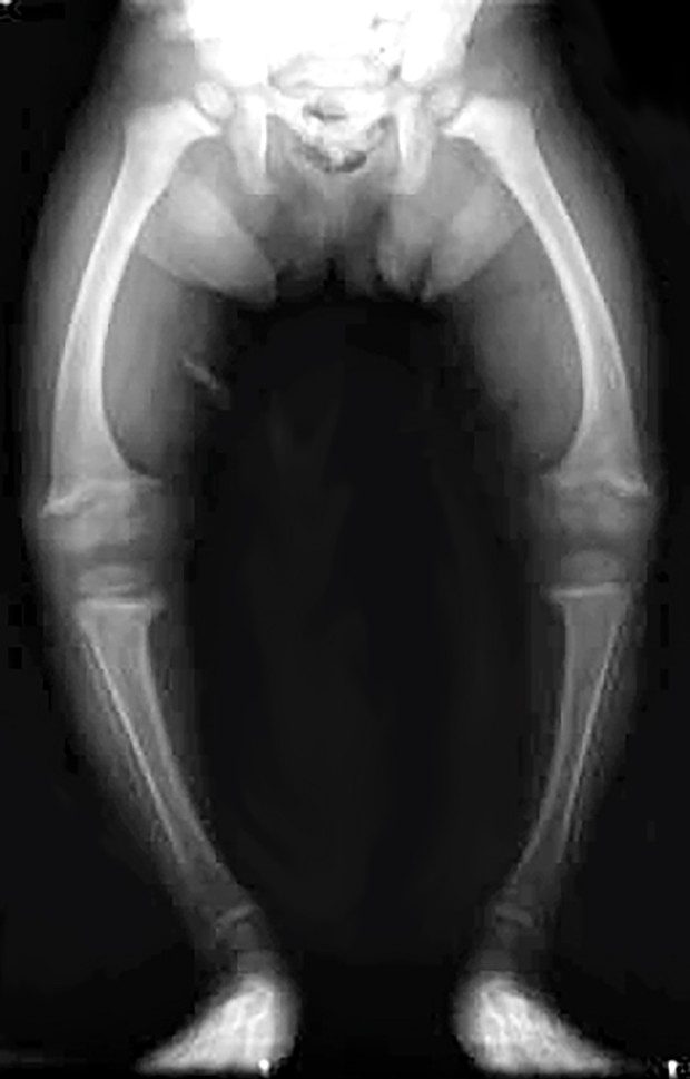 X-ray of a 2-year-old with rickets (linked to insufficient vitamin D), showing bowing of the femurs and decreased bone density.