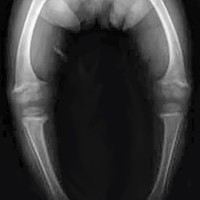 X-ray of a 2-year-old with rickets (linked to insufficient vitamin D), showing bowing of the femurs and decreased bone density.