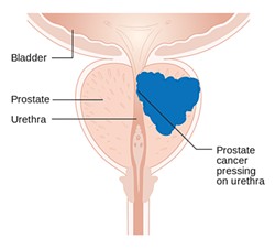 CANCER RESEARCH UK/WIKIMEDIA COMMONS - Two-thirds of men with prostate cancer have no symptoms. Those who do typically experience frequent urination, especially at night, due to the tumor pressing on the urethra.